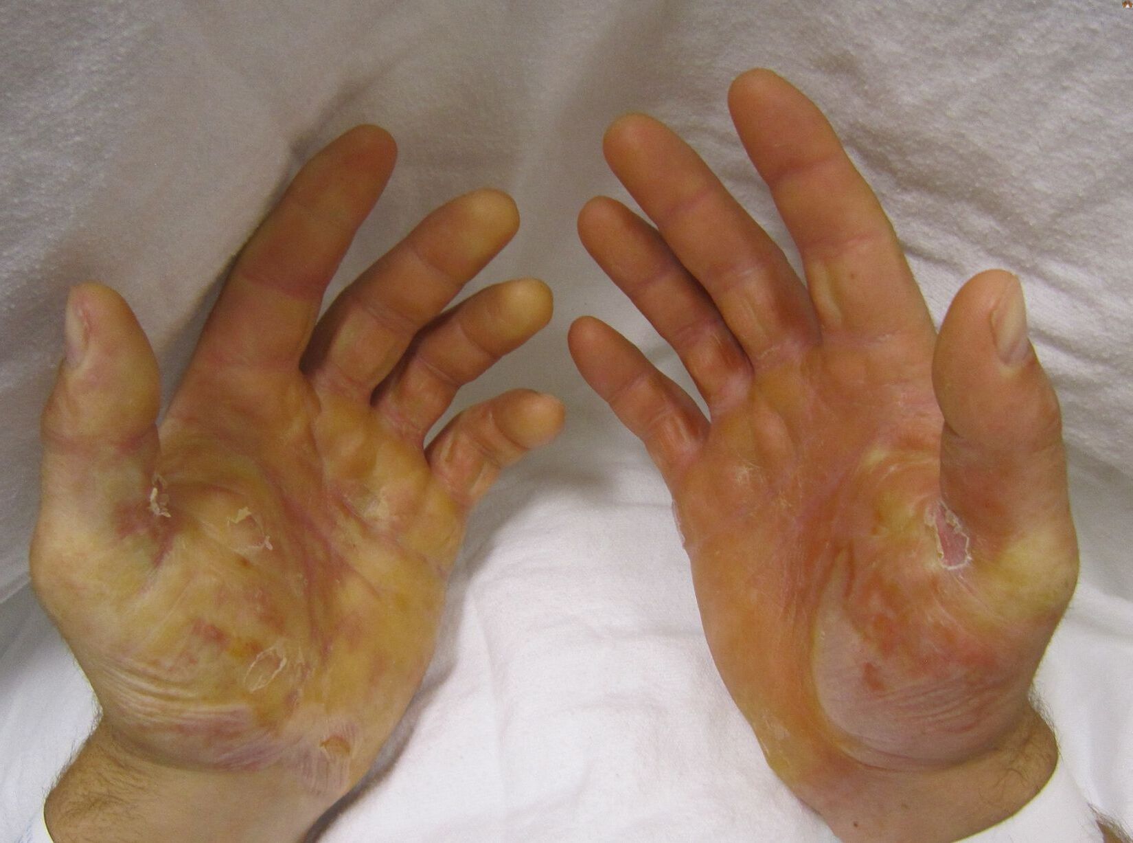 50-facts-about-epidermolysis-bullosa