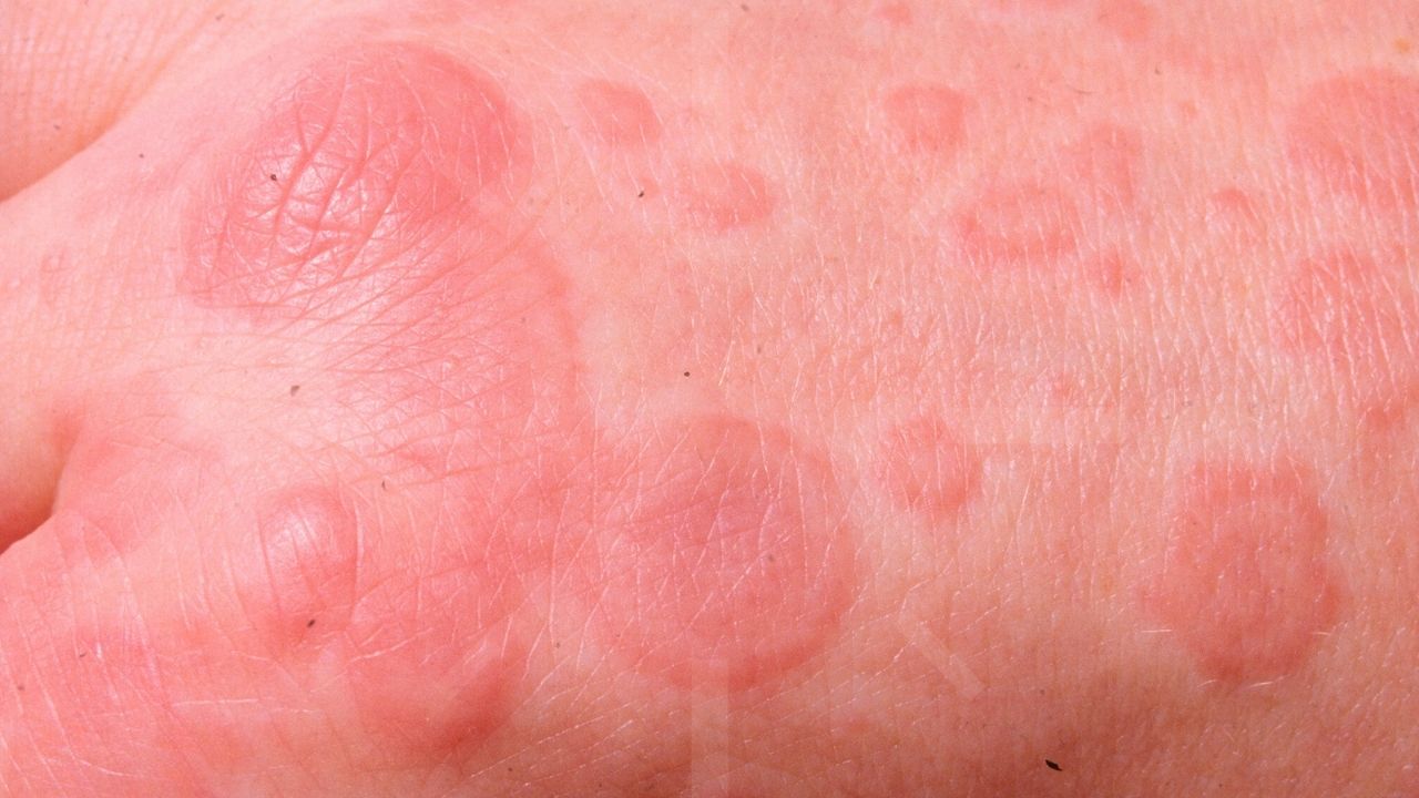 50-facts-about-erythema-multiforme