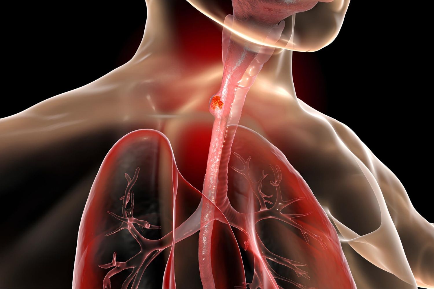 50-facts-about-esophageal-varices