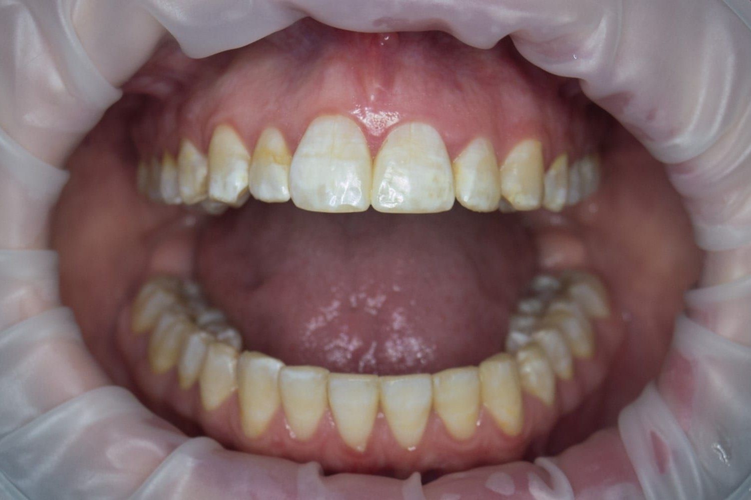 50-facts-about-fluorosis