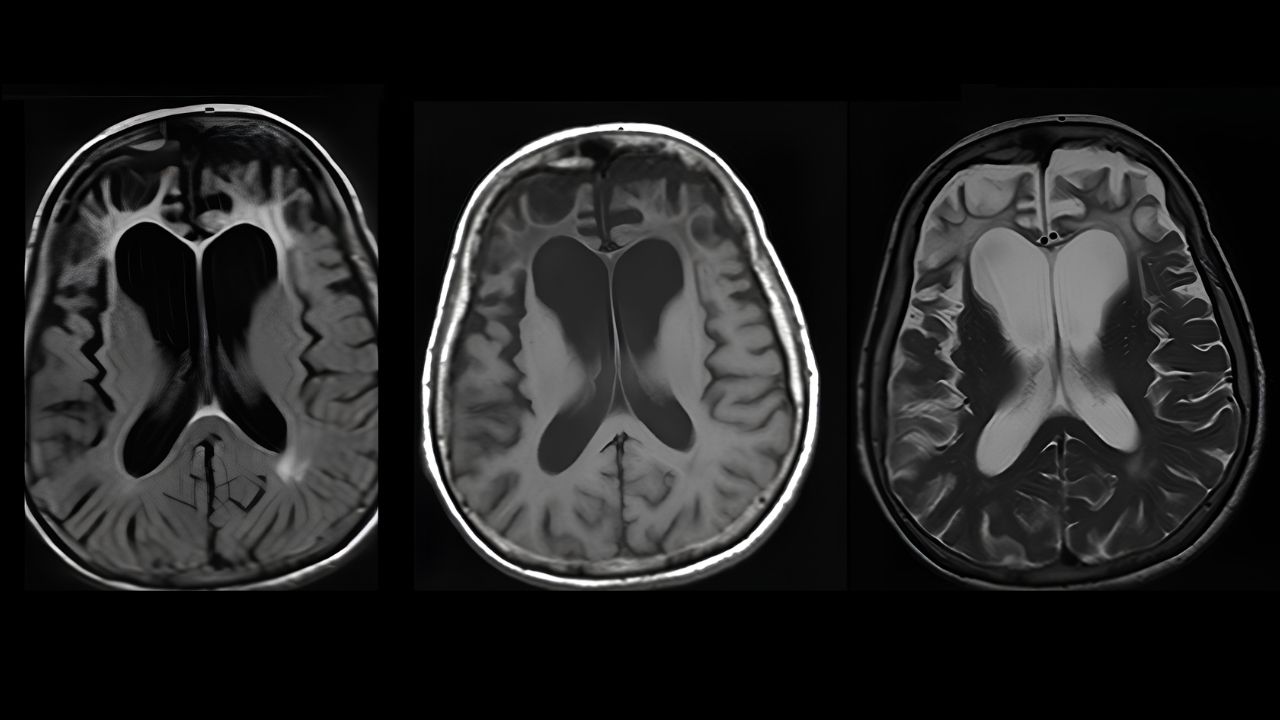 50-facts-about-frontotemporal-dementia