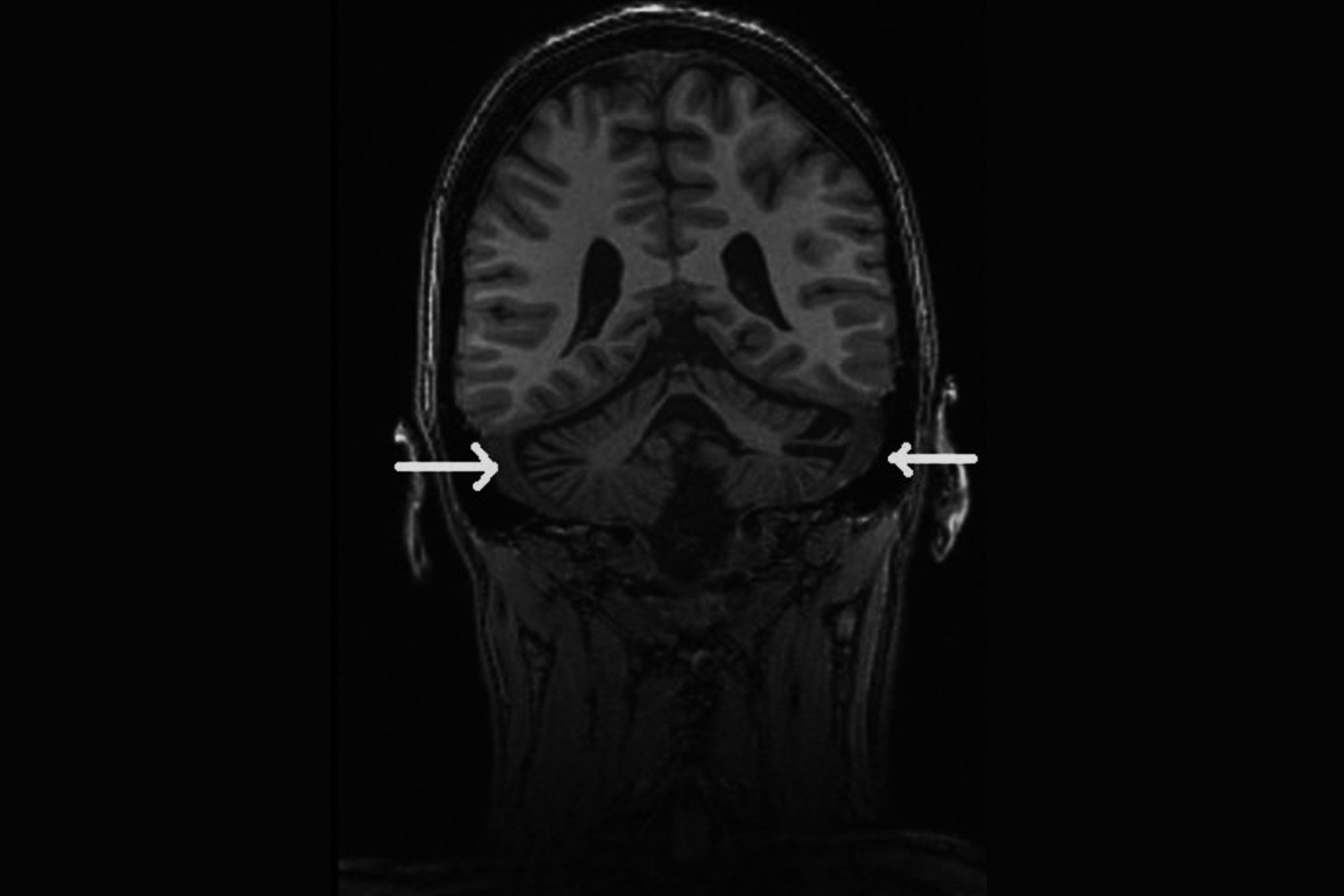 50-facts-about-hereditary-ataxia