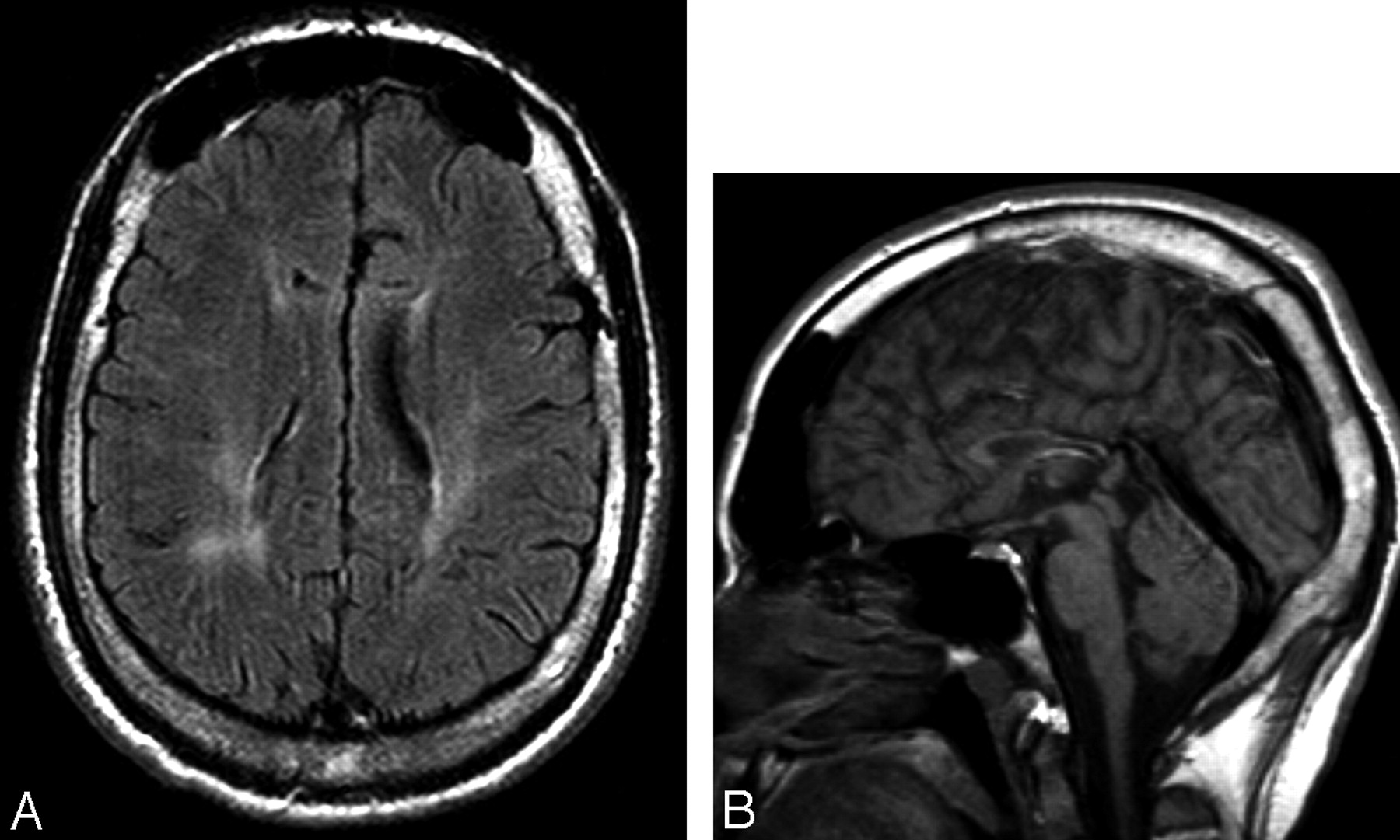 50 Facts About Hereditary Spastic Paraplegia - Facts.net