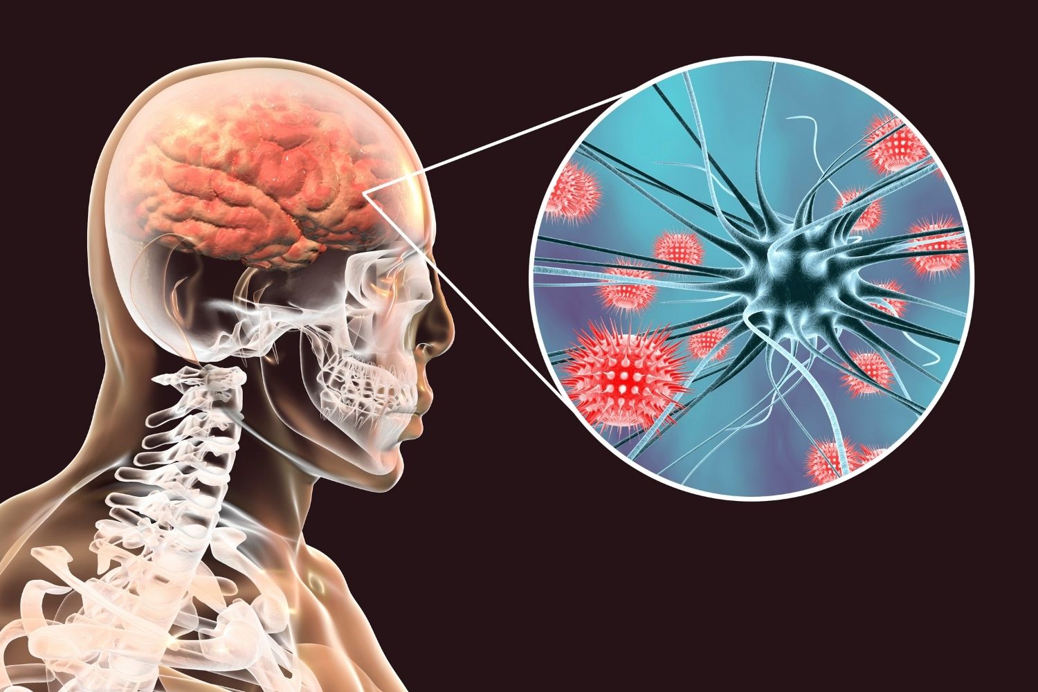 50-facts-about-herpes-encephalitis