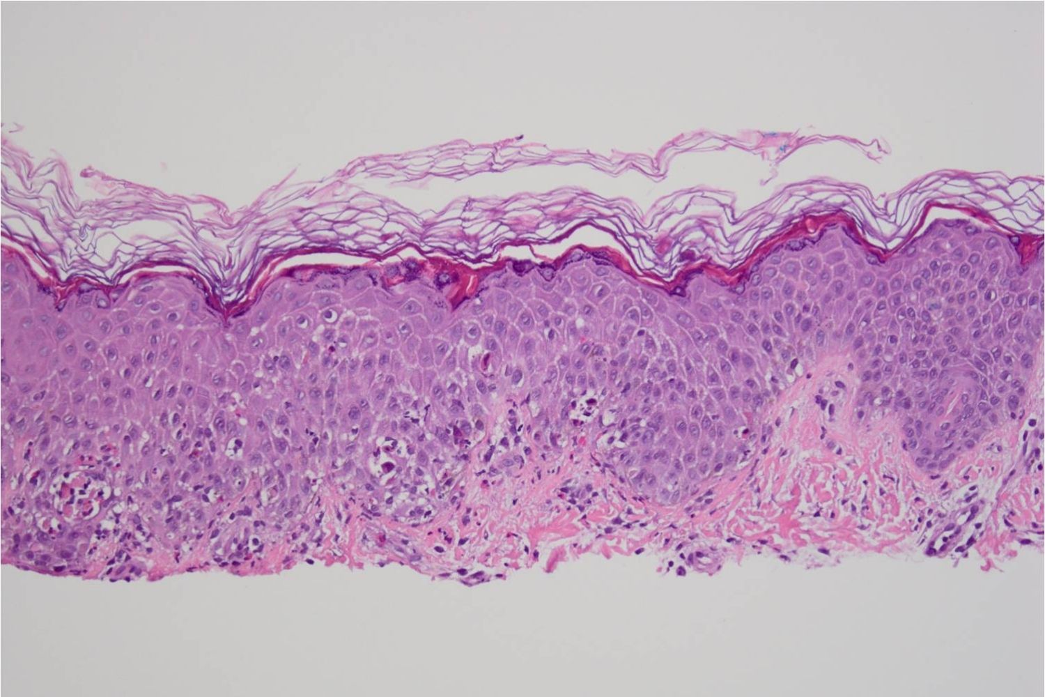 50-facts-about-incontinentia-pigmenti