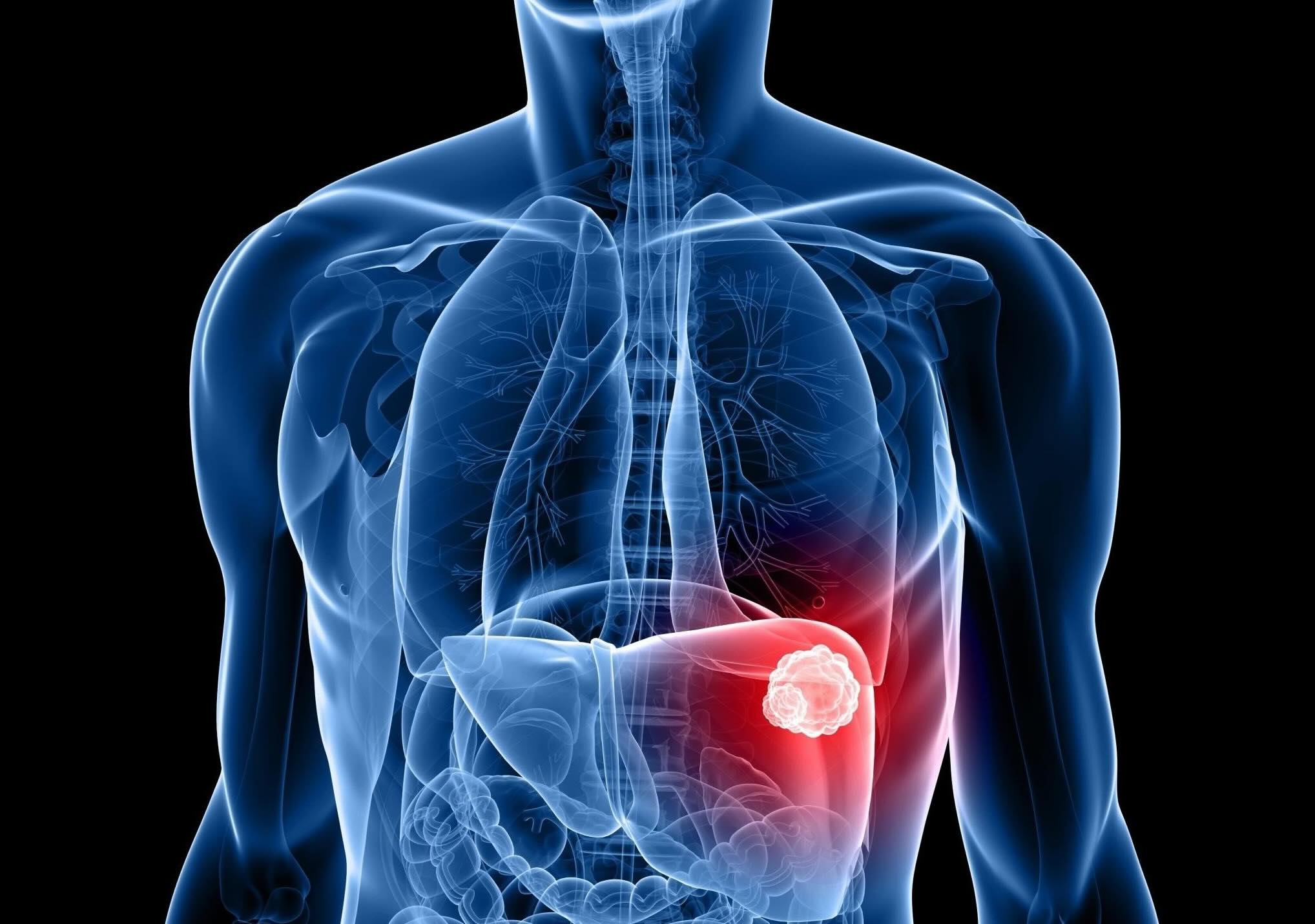 50-facts-about-liver-cancer