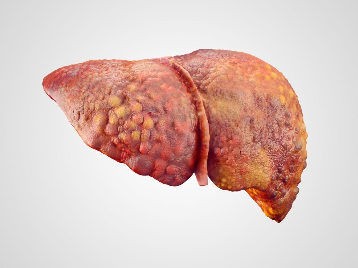 50-facts-about-liver-cirrhosis