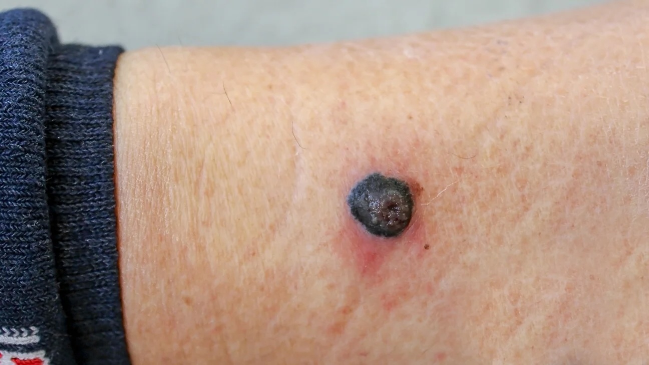 50-facts-about-malignant-melanoma