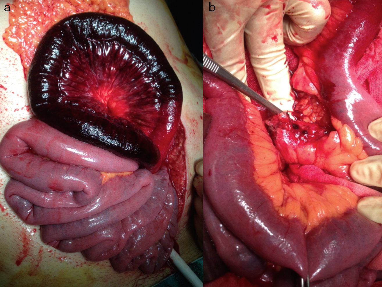 50-facts-about-mesenteric-ischemia