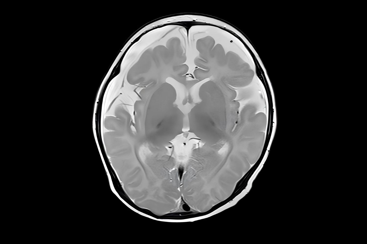 50-facts-about-methylmalonic-acidemia