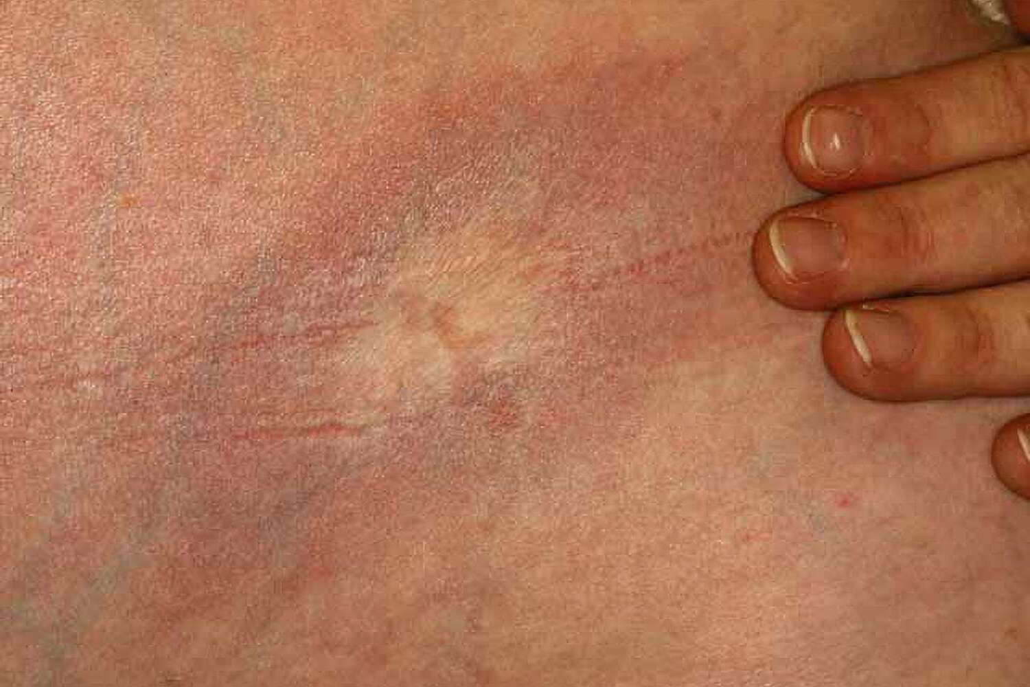 50-facts-about-morphea-scleroderma