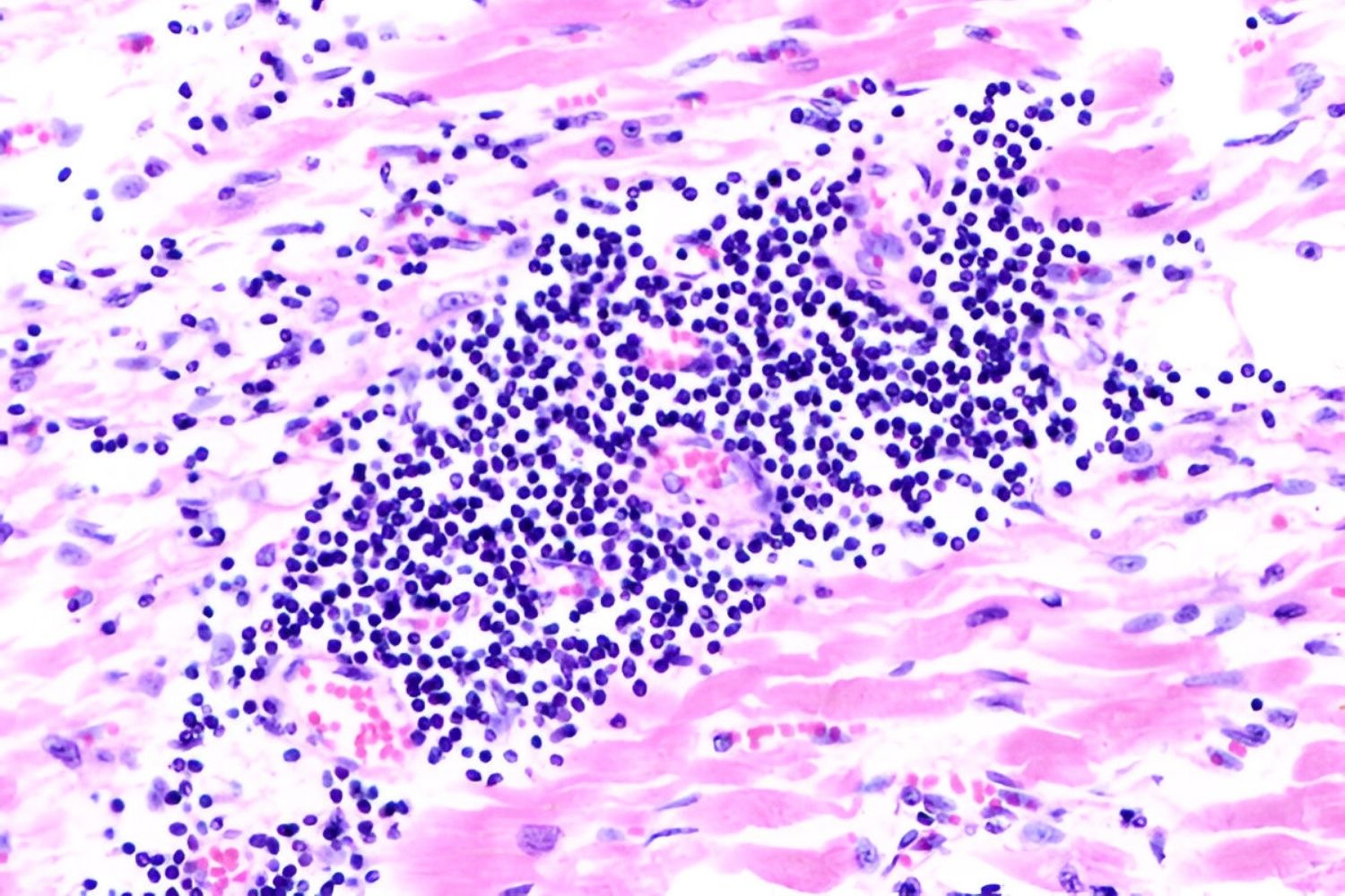 50-facts-about-myocarditis