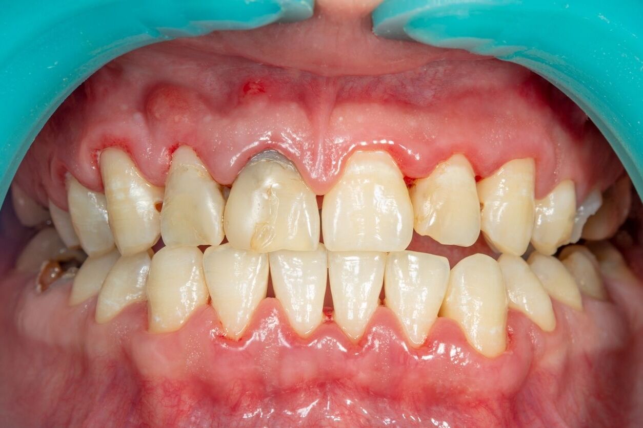 50-facts-about-periodontal-disease