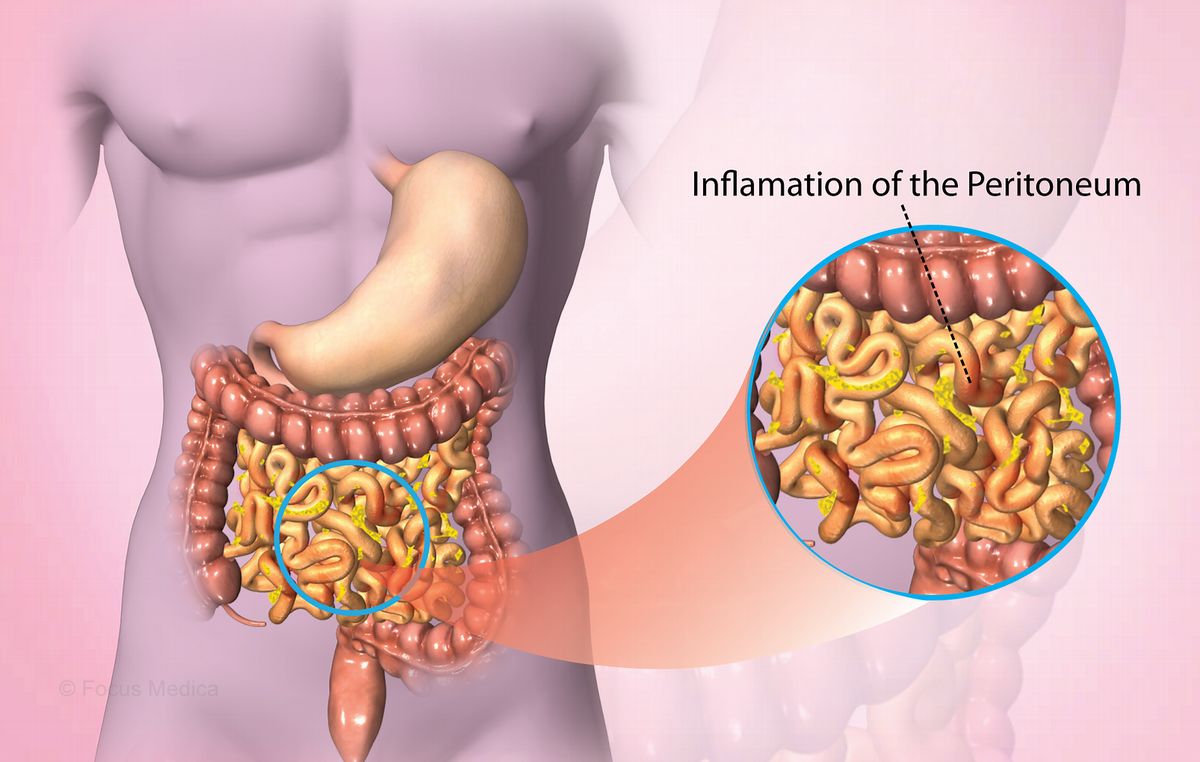 50-facts-about-peritonitis