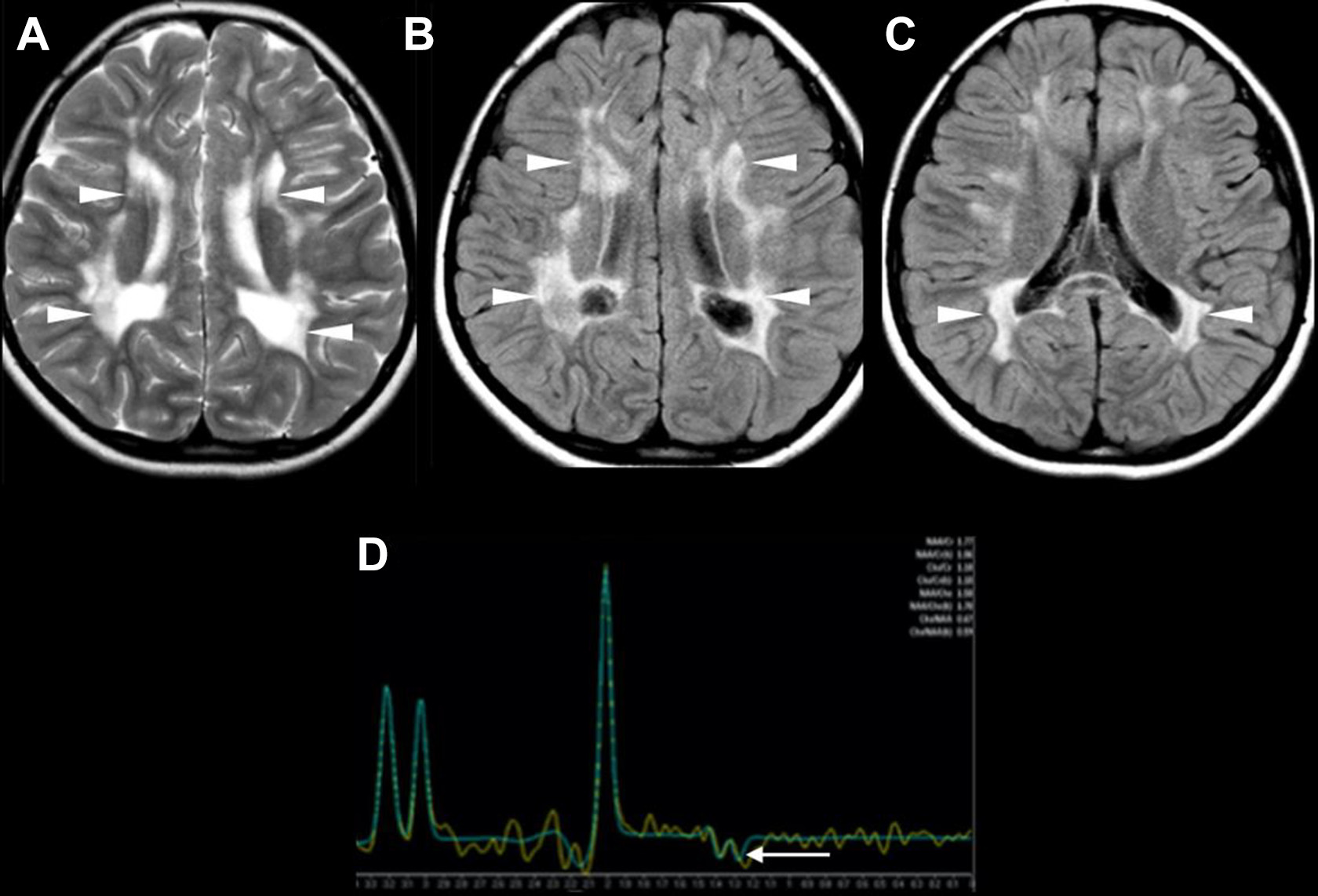 50-facts-about-periventricular-leukomalacia