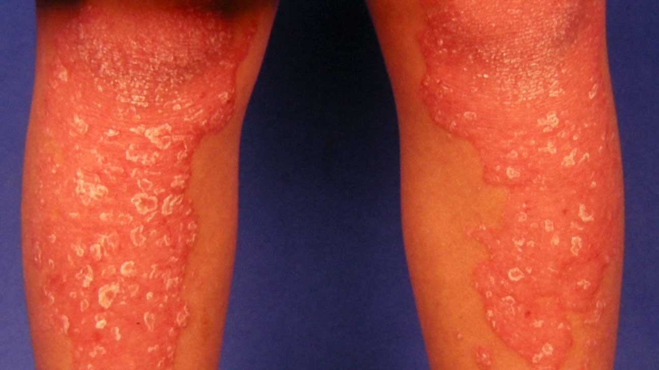 50-facts-about-pityriasis-rubra-pilaris