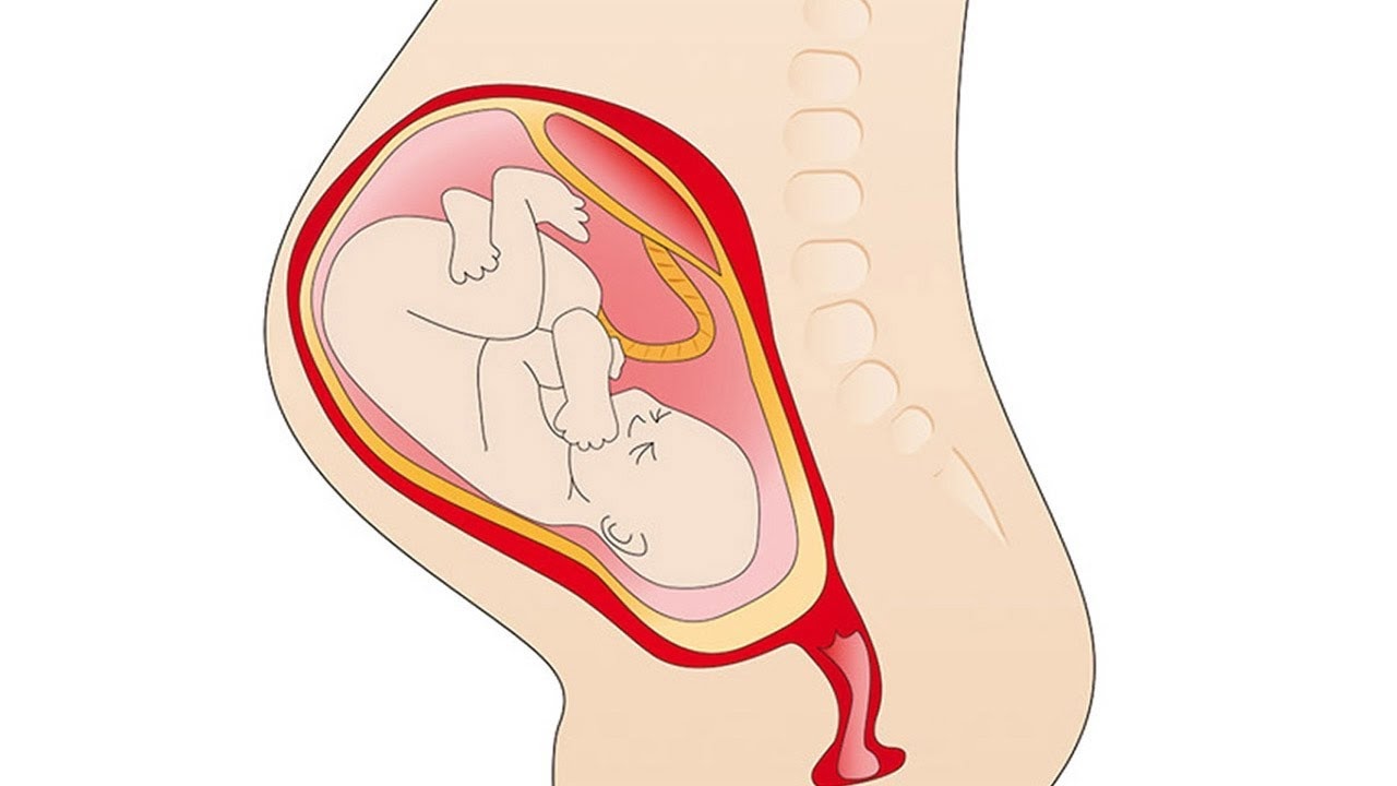 50-facts-about-placental-abruption