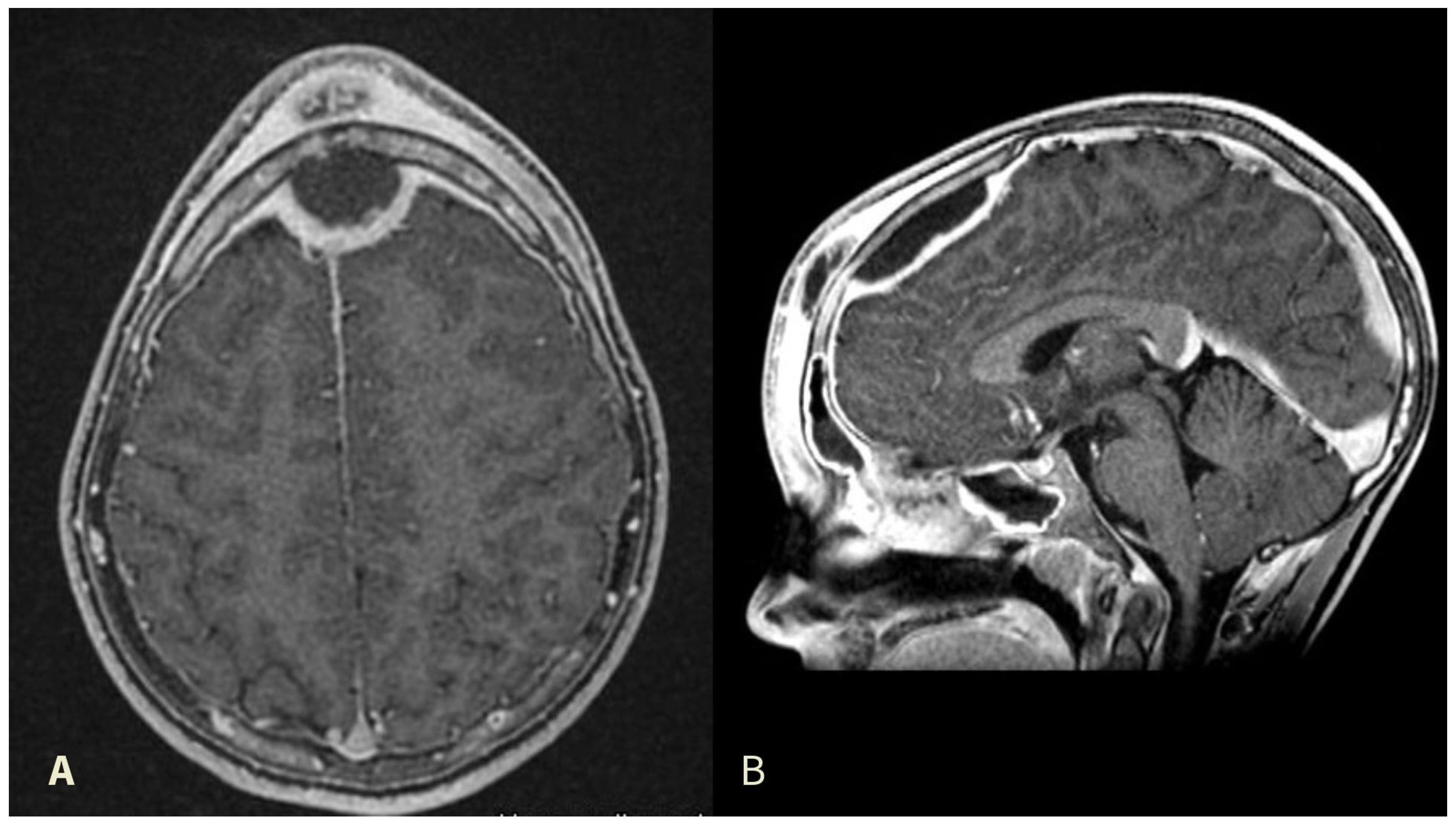 50-facts-about-potts-puffy-tumor