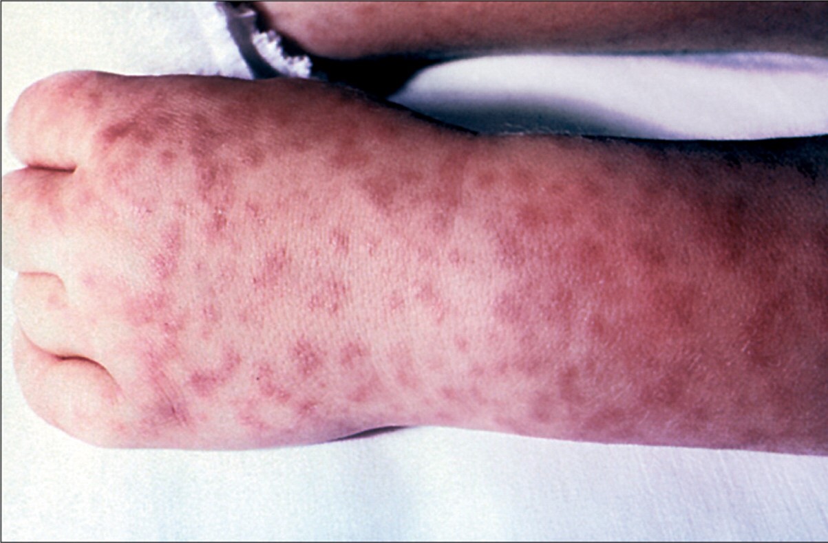 50-facts-about-rocky-mountain-spotted-fever