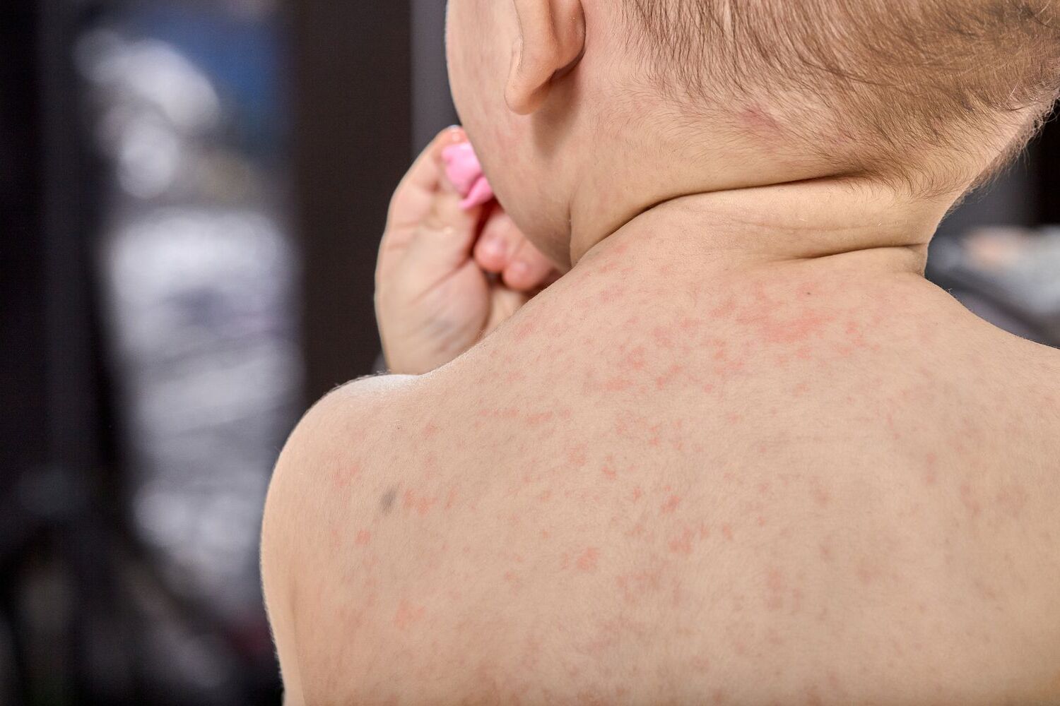 50-facts-about-roseola-infantum