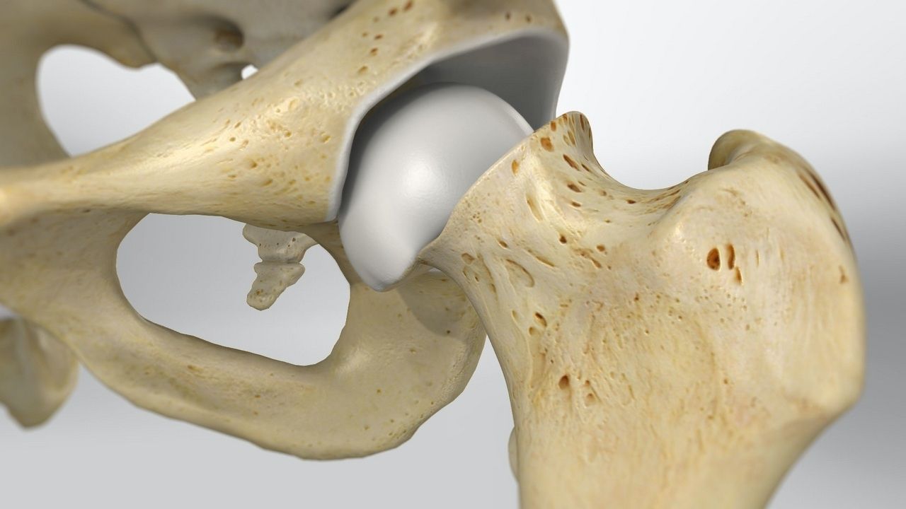 50-facts-about-slipped-capital-femoral-epiphysis