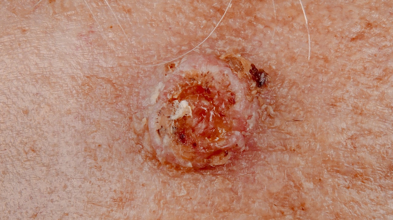 50-facts-about-squamous-cell-skin-cancer