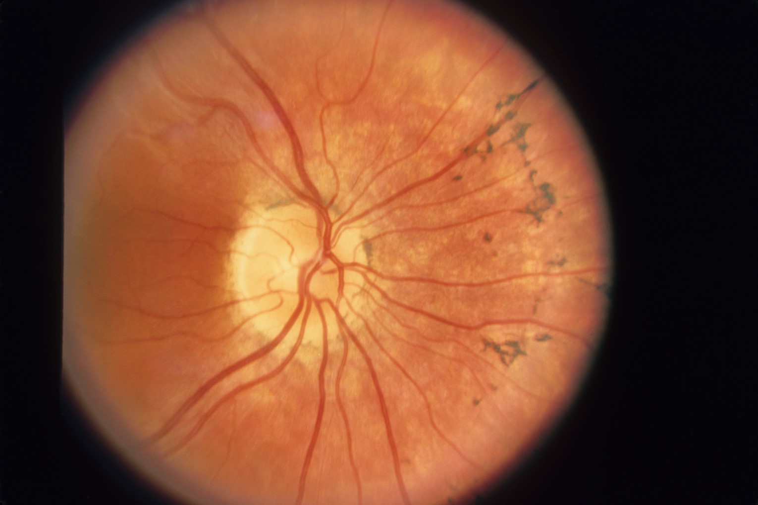 25-facts-about-autosomal-recessive-isolated-optic-atrophy