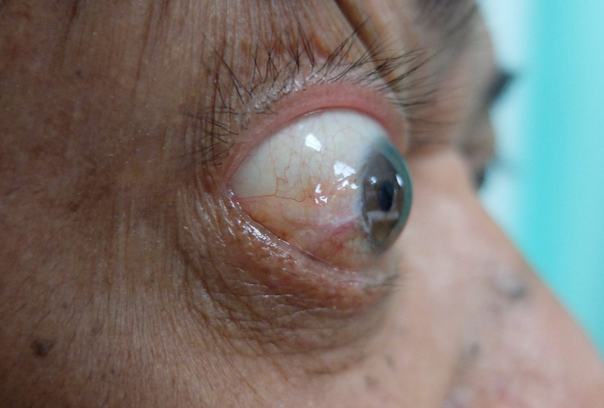 25-facts-about-basedow-ocular-syndrome