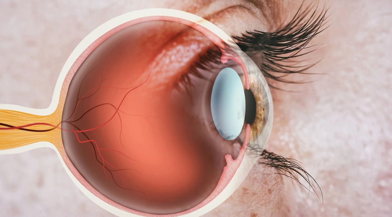 25-facts-about-familial-bilateral-optic-nerve-hypoplasia-onh