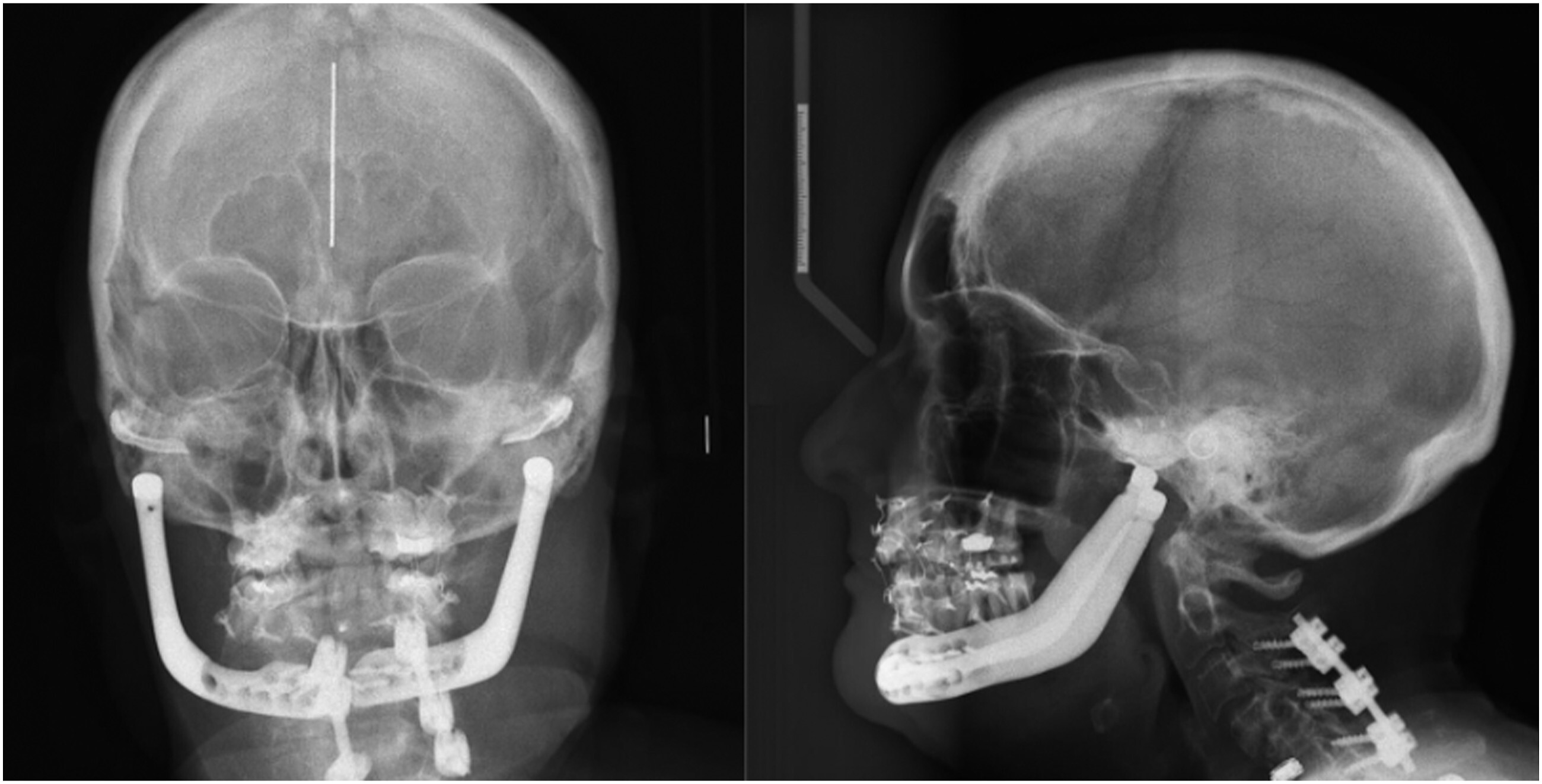 25 Facts About Gorham–Stout Disease - Facts.net