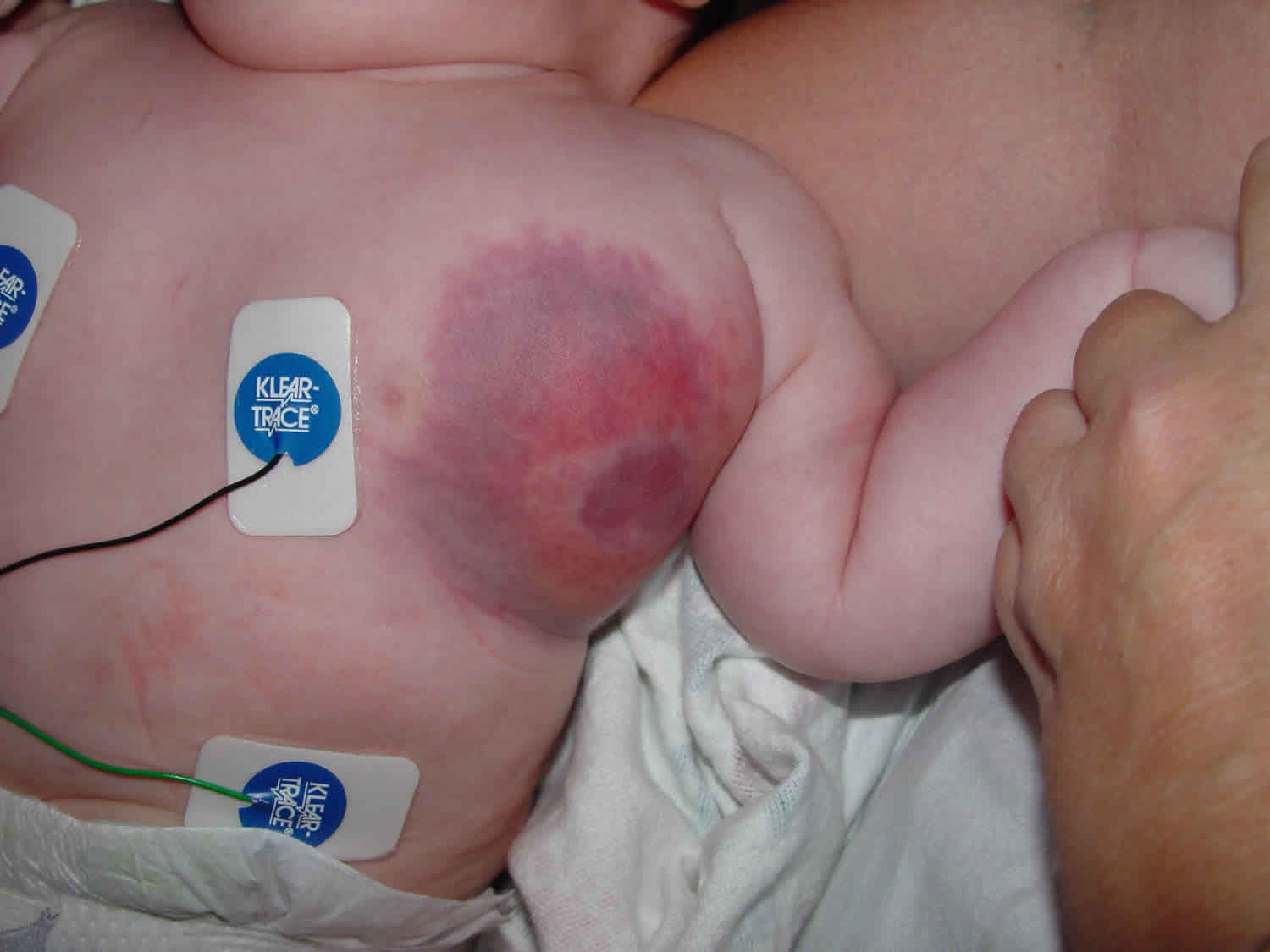 25-facts-about-hemangioma-thrombocytopenia