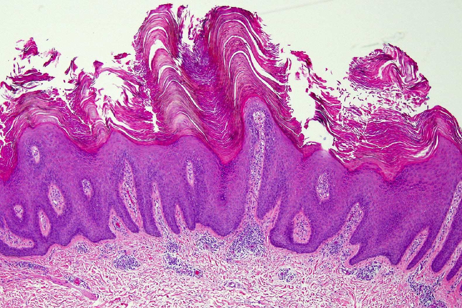 25-facts-about-ichthyosis-hystrix-of-curth-macklin-ihcm