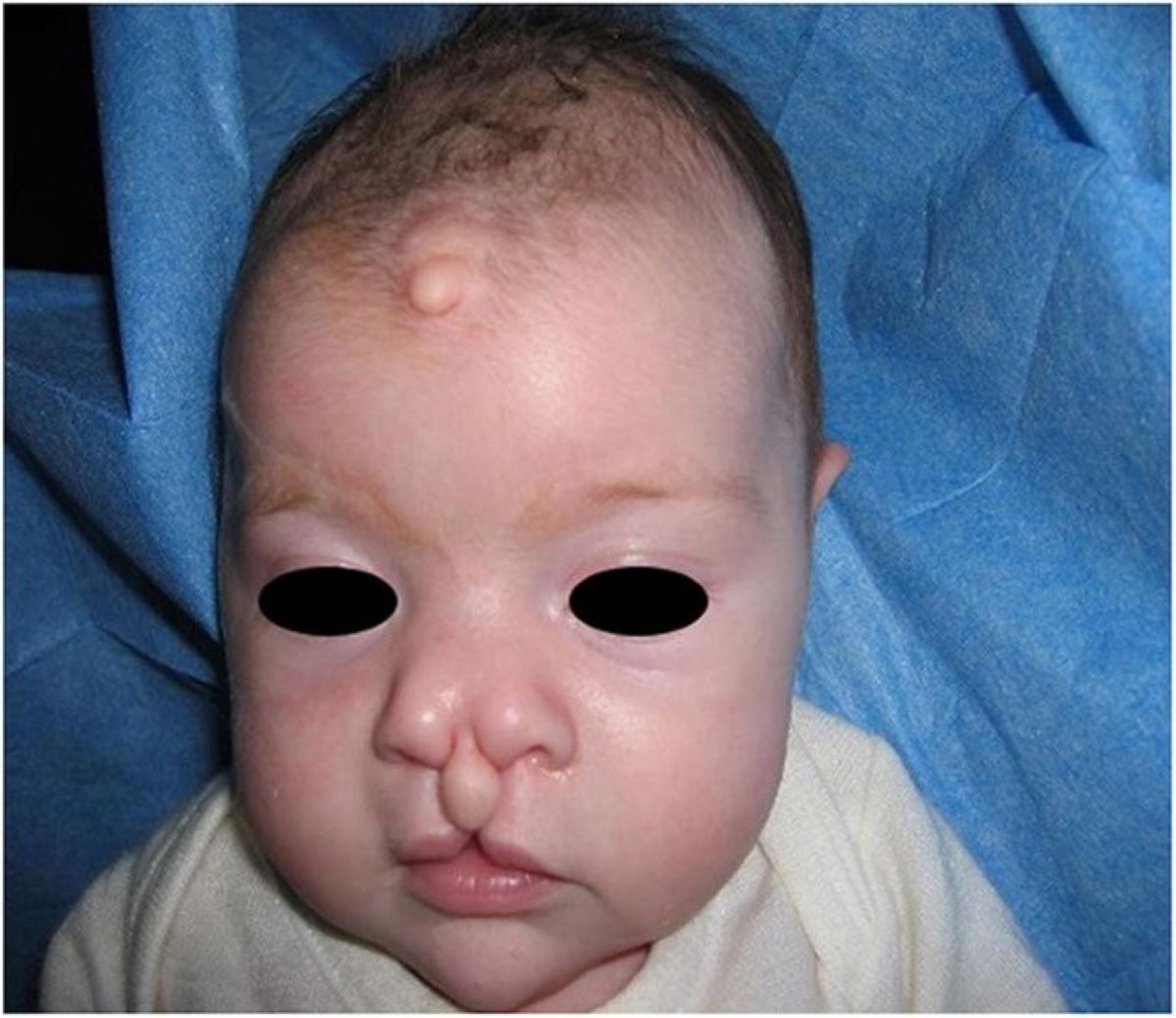 25-facts-about-median-cleft-lip-corpus-callosum-lipoma-skin-polyps