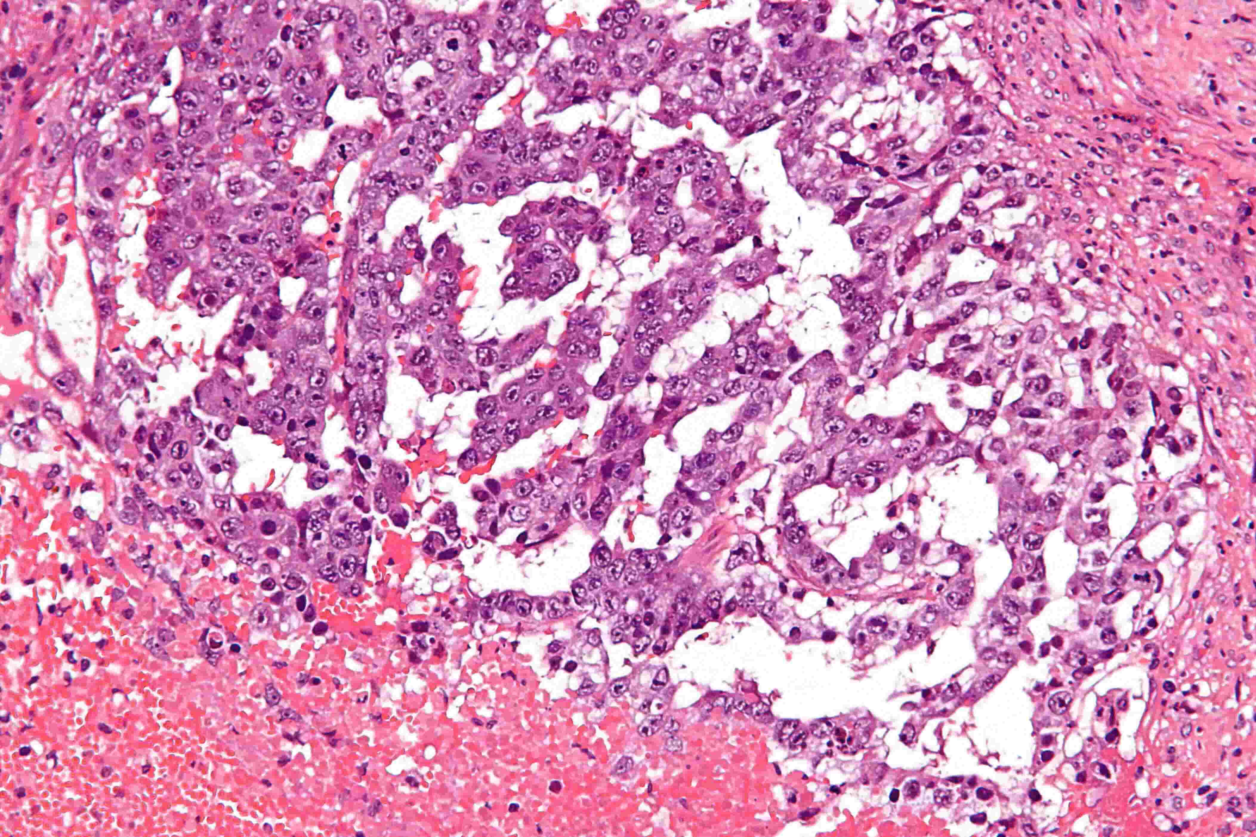 25-facts-about-mediastinal-endodermal-sinus-tumors