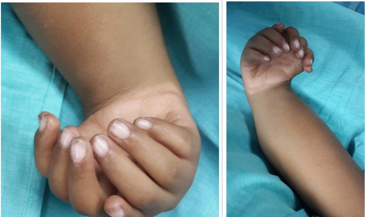 25-facts-about-mirror-hands-feet-nasal-defects