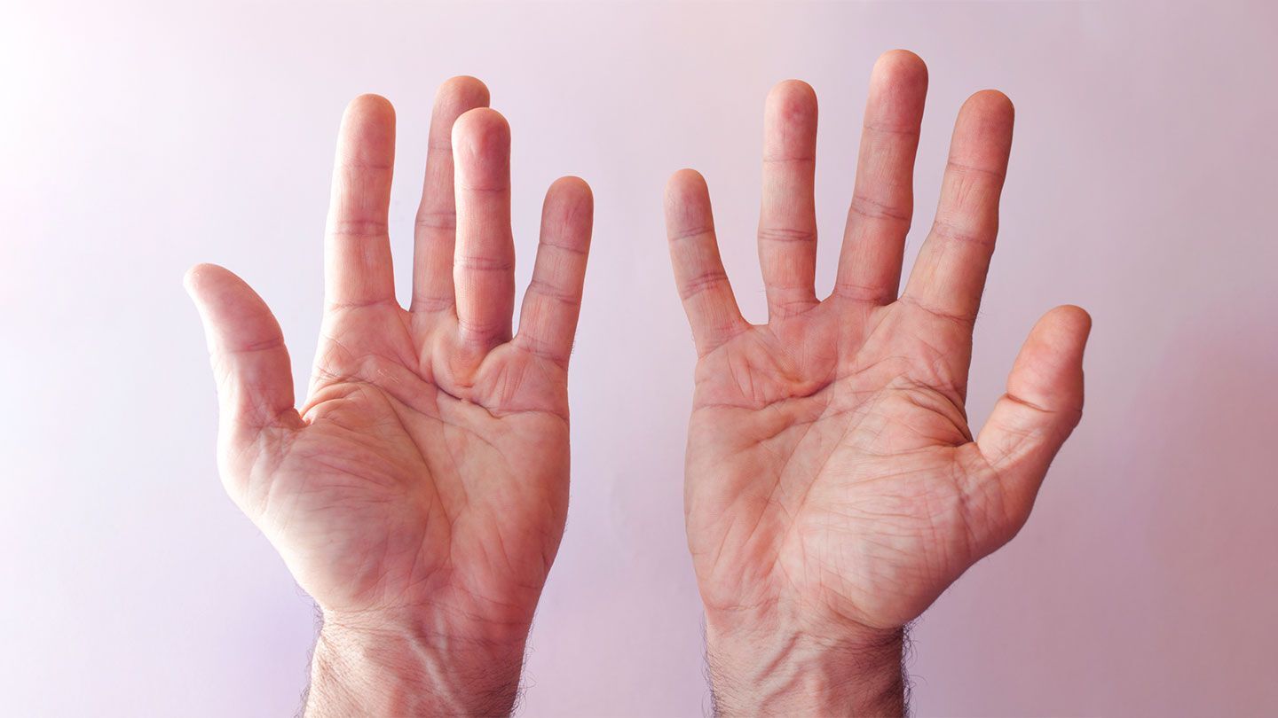 25-facts-about-multiple-contracture-finnish-type