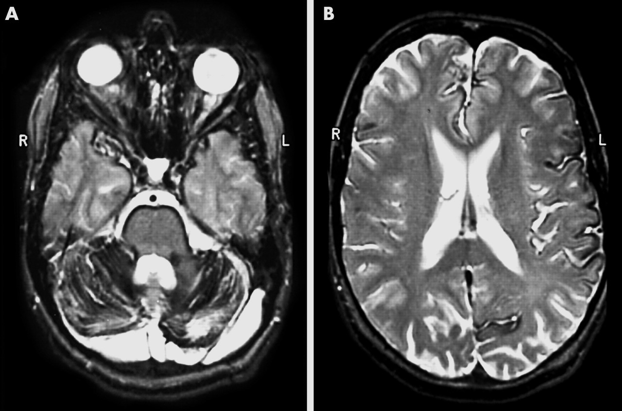 25-facts-about-olivopontocerebellar-atrophy-deafness