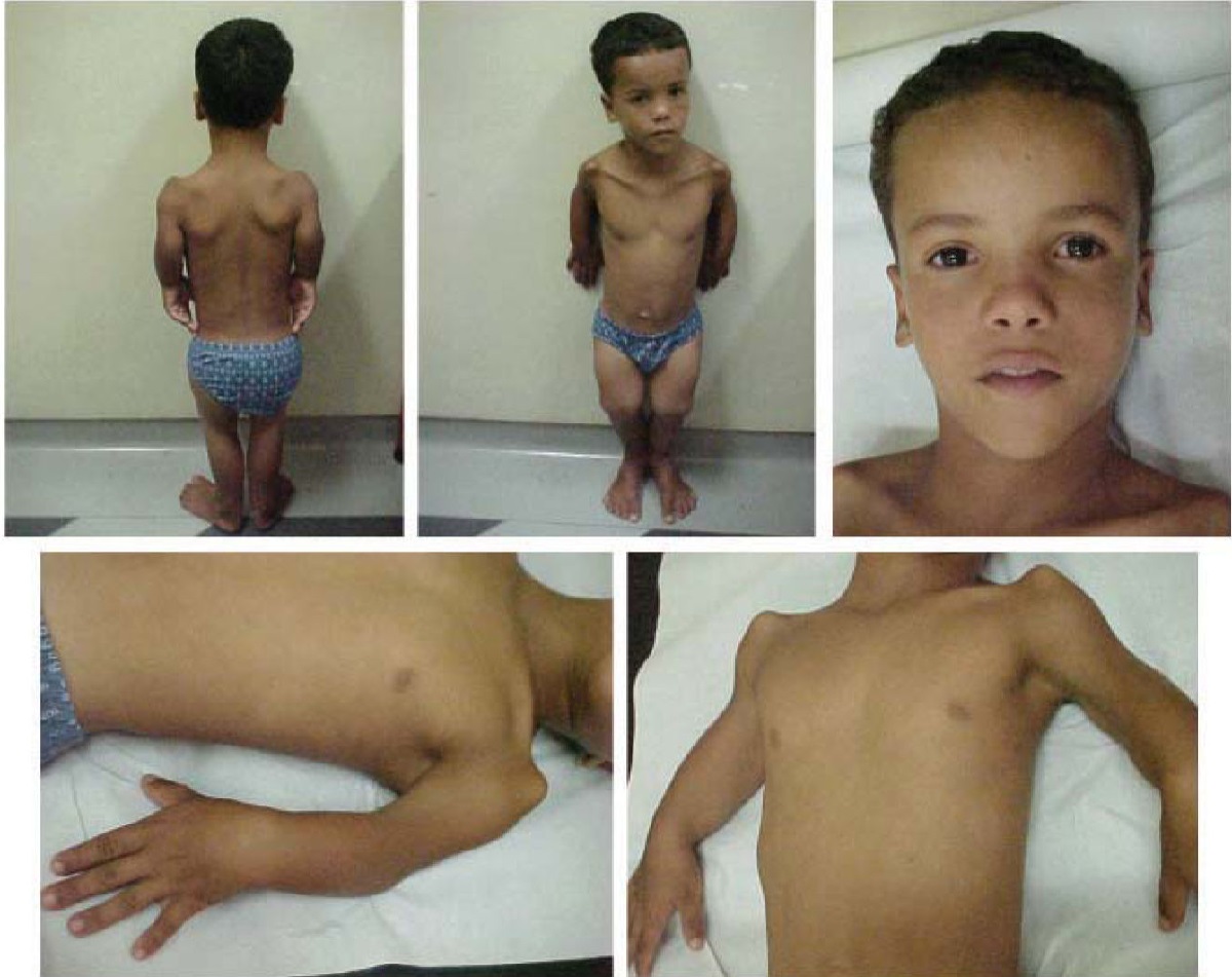 25-facts-about-omodysplasia-type-1