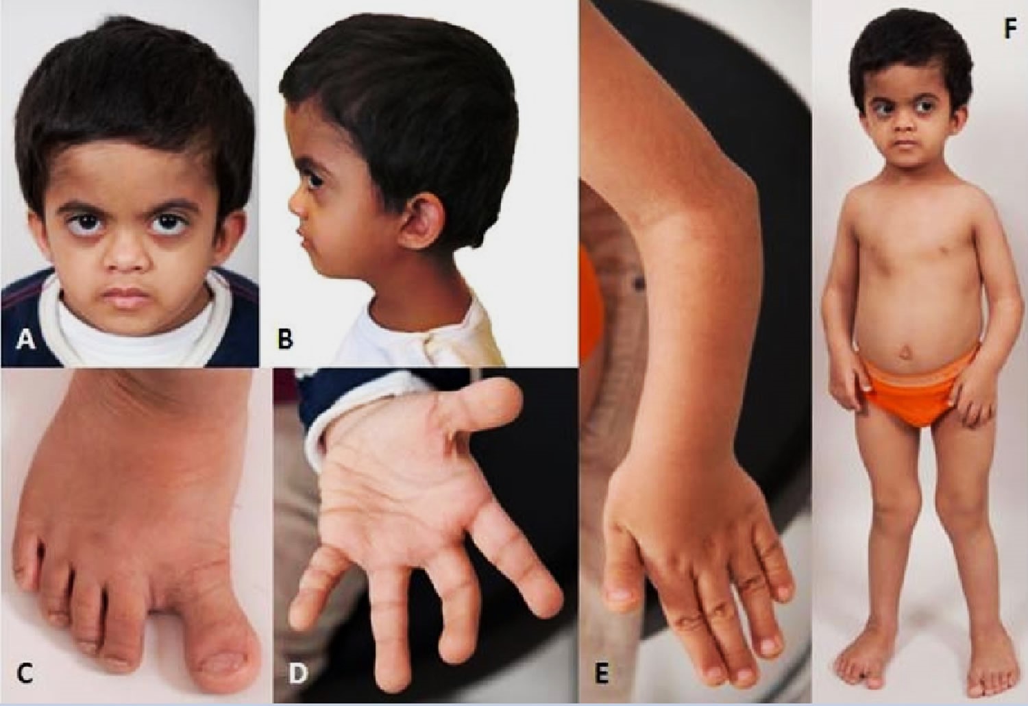 25-facts-about-omodysplasia-type-2