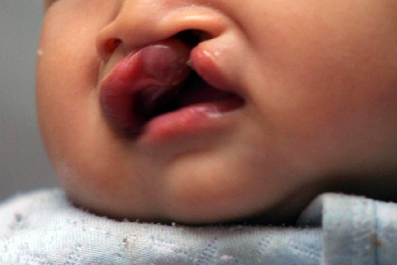 25-facts-about-oral-facial-cleft