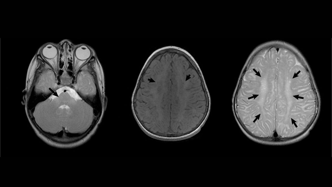 25-facts-about-pelizaeus-merzbacher-brain-sclerosis