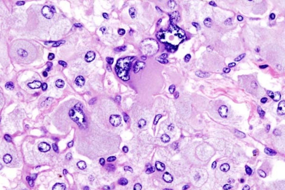 25-facts-about-pheochromocytoma-as-part-of-nf