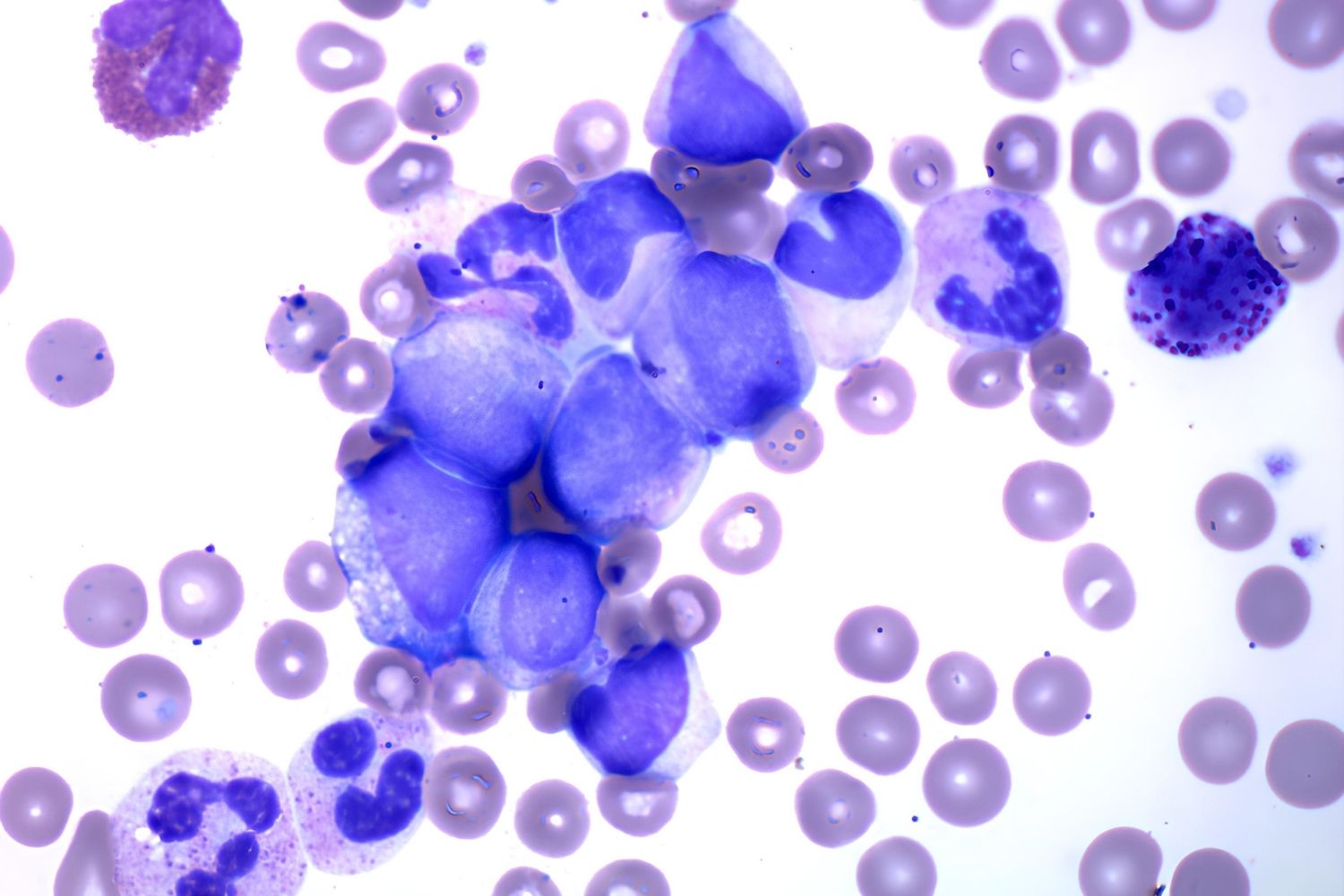 25-facts-about-philadelphia-negative-chronic-myeloid-leukemia