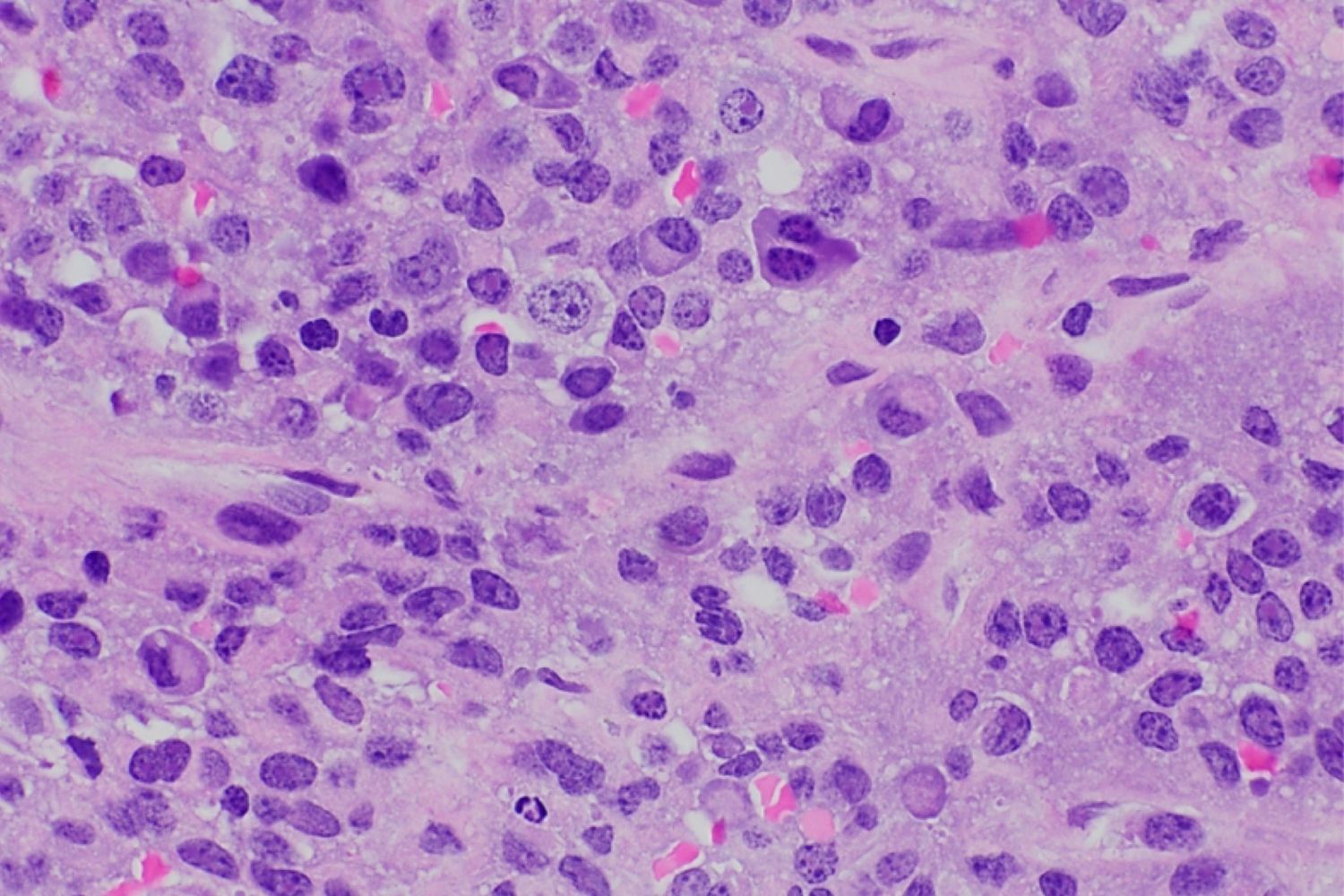 25-facts-about-plasmacytoma-anaplastic