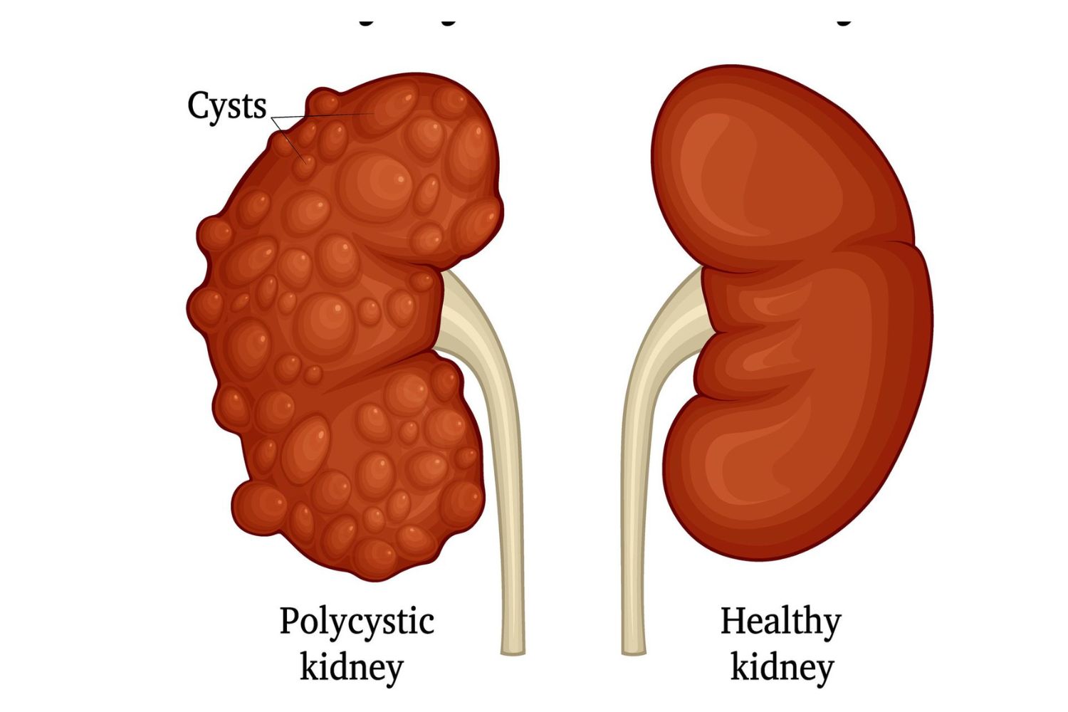 25-facts-about-polycystic-kidney-disease-pkd-type-2