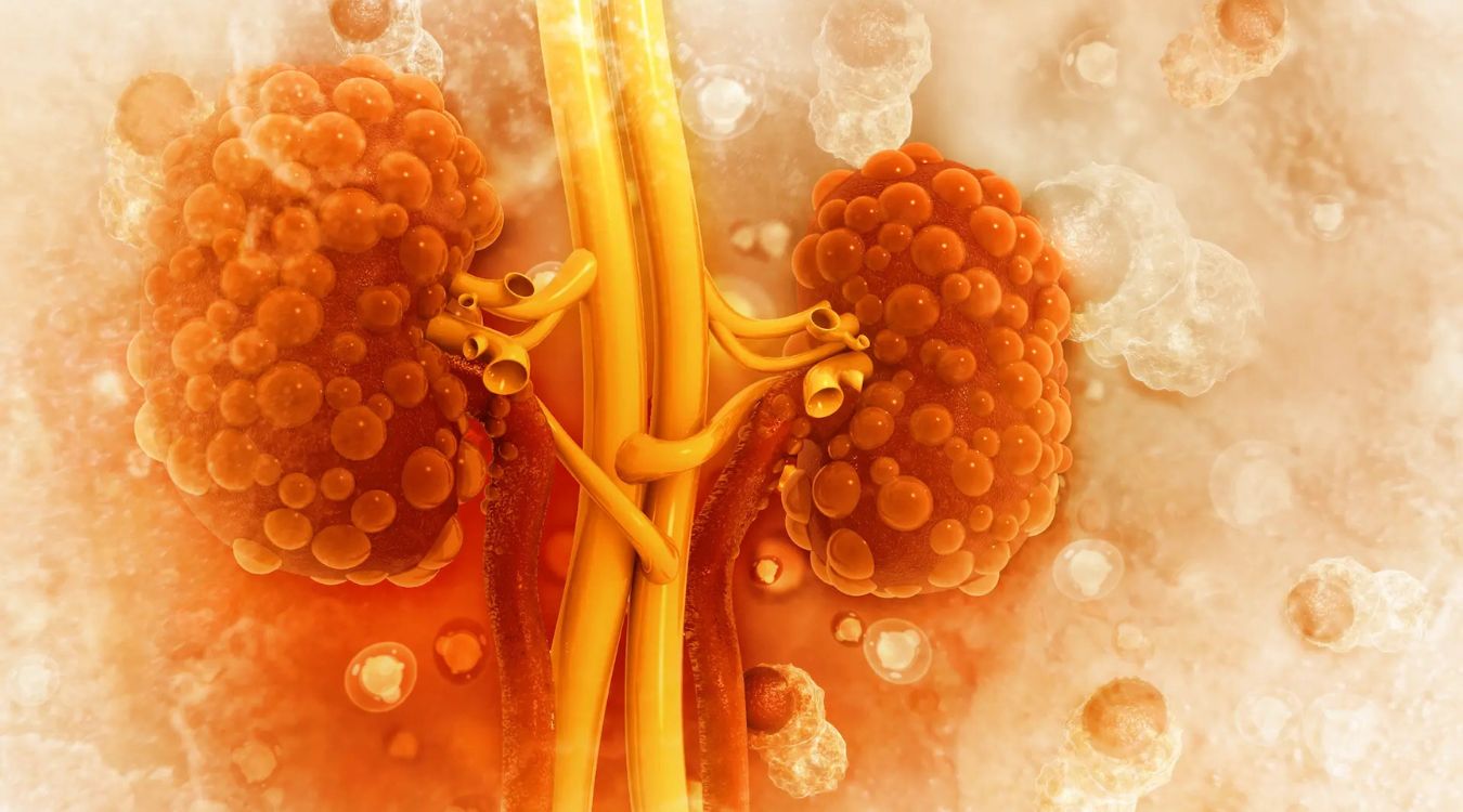 25-facts-about-polycystic-kidney-disease-type-3-pkd3