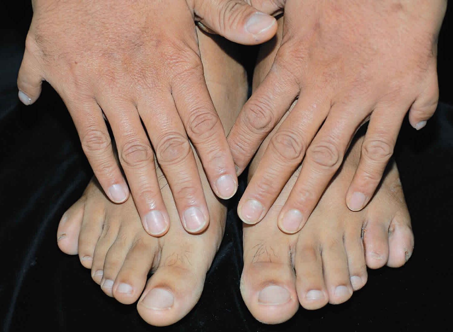 25-facts-about-preaxial-deficiency-postaxial-polydactyly-hypospadia