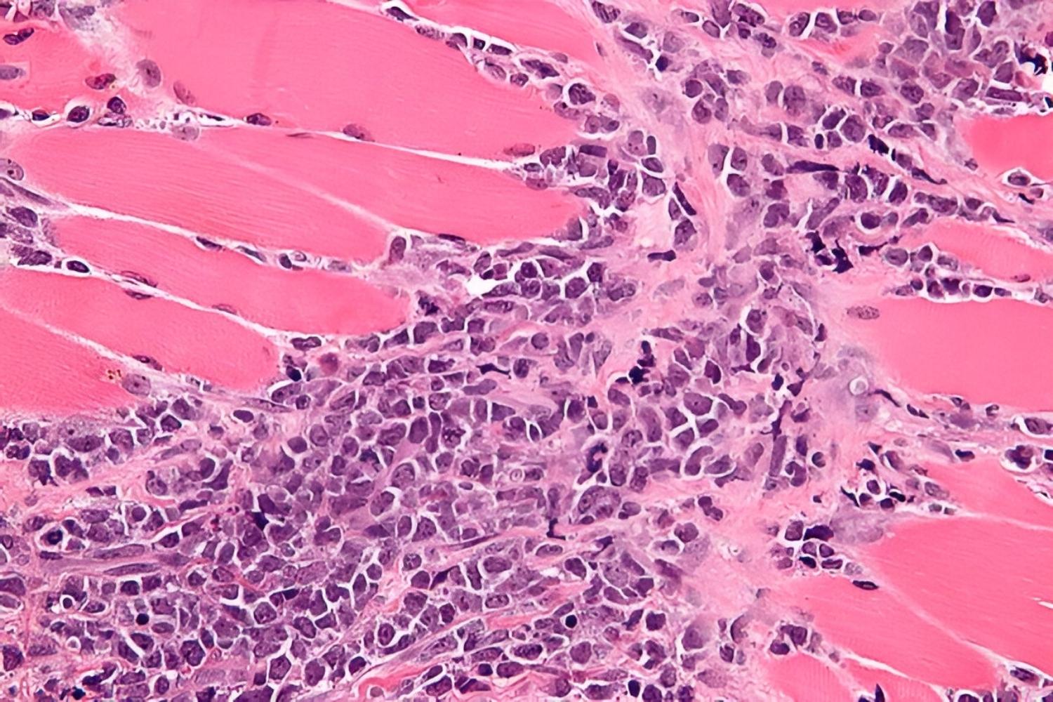 25-facts-about-primary-granulocytic-sarcoma