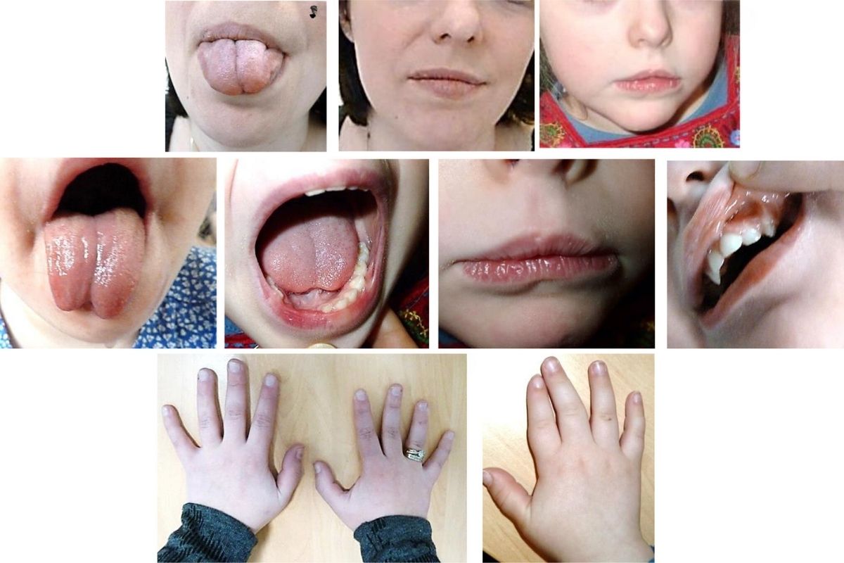 25-facts-about-radio-digito-facial-dysplasia