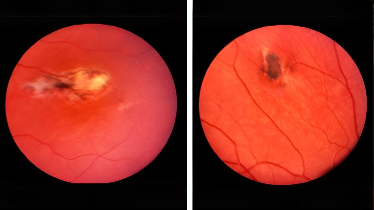 25-facts-about-radioulnar-synostosis-retinal-pigment-abnormalities